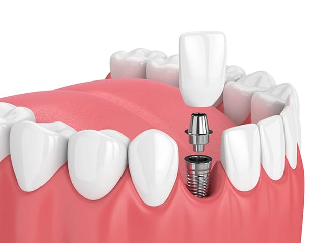 Cross-sectional illustration of a dental implant with abutment and crown inside the gum tissue